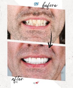before-after photo installation-of-a-veneer