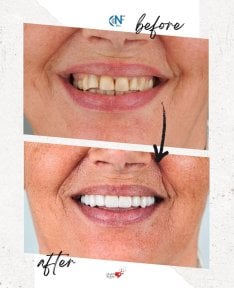before-after photo installation-of-a-veneer