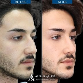 before-after photo rhinoplasty-nose-job