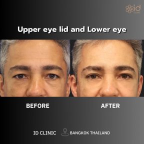 before-after photo upper-eyelid-surgery