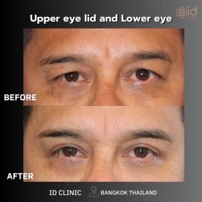 before-after photo upper-eyelid-surgery