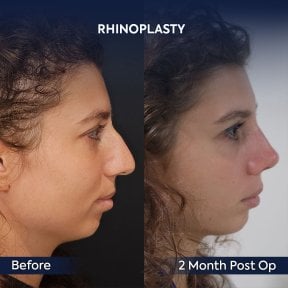 before-after photo rhinoplasty-nose-job