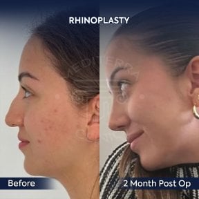 before-after photo rhinoplasty-nose-job