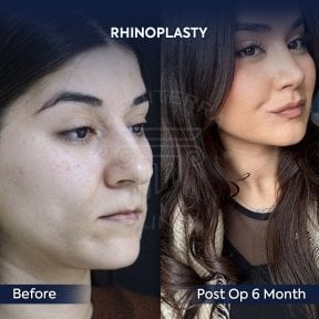 before-after photo rhinoplasty-nose-job