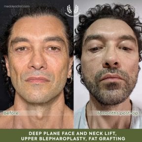 before-after photo lipomodelirovanie-lica