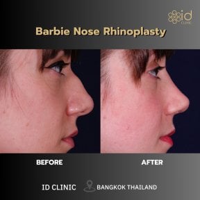 before-after photo bulbous-nose-rhinoplasty
