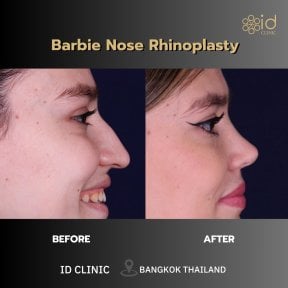 before-after photo bulbous-nose-rhinoplasty