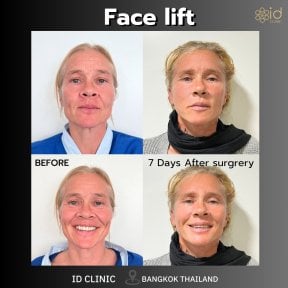 before-after photo tightening-of-facial-skin-facelift