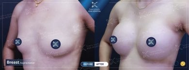 Before and after breast implant revision results at Asia Cosmetic Hospital, enhanced breast shape
