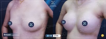Before and after breast implant revision results at Asia Cosmetic Hospital, enhanced breast shape