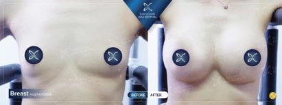 Before and after breast implant revision results at Asia Cosmetic Hospital, enhanced breast shape