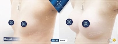 Before and after breast implant revision results at Asia Cosmetic Hospital, enhanced breast shape