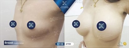 Before and after breast implant revision results at Asia Cosmetic Hospital, enhanced breast shape
