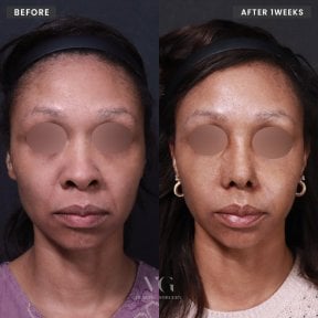 Before and after rhinoplasty result at VG Plastic Surgery, nose reshaping after 1 week