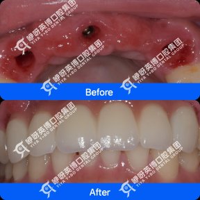 Результати до і після імплантації зубів у Shanghai Y+bo Dental Clinic, відновлення верхніх зубів