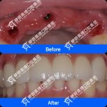 Результати до і після імплантації зубів у Shanghai Y+bo Dental Clinic, відновлення верхніх зубів