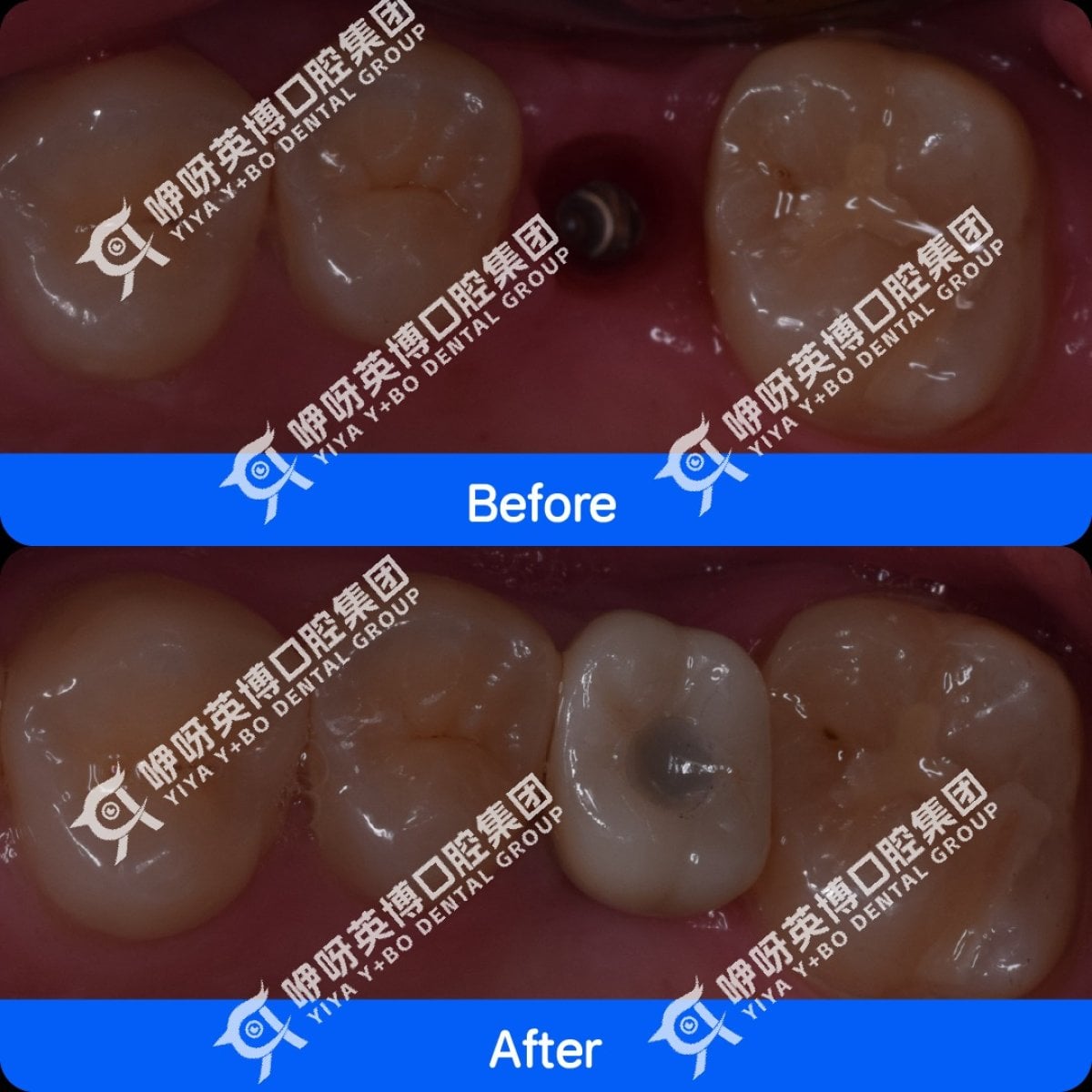 Resultados de implante dental antes y después en Shanghai Y+bo Dental Clinic, molar restaurado
