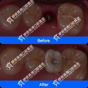 Результати до і після імплантації зуба в Shanghai Y+bo Dental Clinic, відновлений моляр
