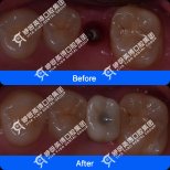Результати до і після імплантації зуба в Shanghai Y+bo Dental Clinic, відновлений моляр
