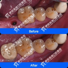 Результати до та після імплантації зуба в Shanghai Y+bo Dental Clinic, відновлення зуба