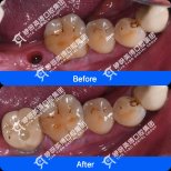 Результати до та після імплантації зуба в Shanghai Y+bo Dental Clinic, відновлення зуба