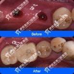 Before and after dental implant results at Shanghai Y+bo Dental Clinic, restored molars