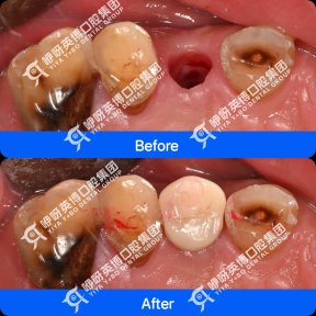 Результати до і після імплантації зуба в Shanghai Y+bo Dental Clinic, відновлення зуба