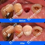 Результати до і після імплантації зуба в Shanghai Y+bo Dental Clinic, відновлення зуба