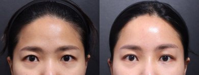 Before and after face contouring results at VG Plastic Surgery, improved facial symmetry shown