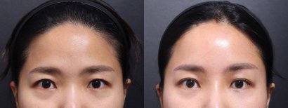 Before and after face contouring results at VG Plastic Surgery, improved facial symmetry shown