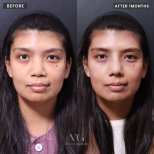 Before and after face contouring results at VG Plastic Surgery, visible facial shape enhancement