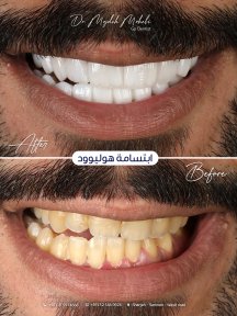Before and after veneers result at Dr. Mojdeh Mohebi clinic – Hollywood smile transformation