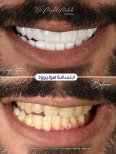 Before and after veneers result at Dr. Mojdeh Mohebi clinic – Hollywood smile transformation