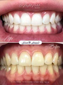 Before and after teeth whitening results at Dr. Mojdeh Mohebi clinic, brighter smile achieved