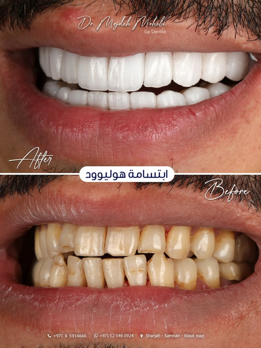 نتيجة الفينير قبل وبعد في عيادة د. مجده محبي – تحول ابتسامة ملحوظ
