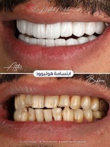 Before and after veneers result at Dr. Mojdeh Mohebi clinic – smile makeover transformation