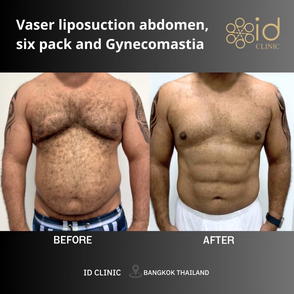 Resultados antes y después de ginecomastia y liposucción Vaser en ID Clinic Bangkok, abdomen definido