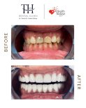 نتيجة قبل وبعد زراعة الأسنان All-on-6 في TH Dental Clinic – تحول الابتسامة