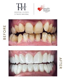 نتيجة قبل وبعد زراعة الأسنان All-on-6 في عيادة TH Dental، تحول الابتسامة