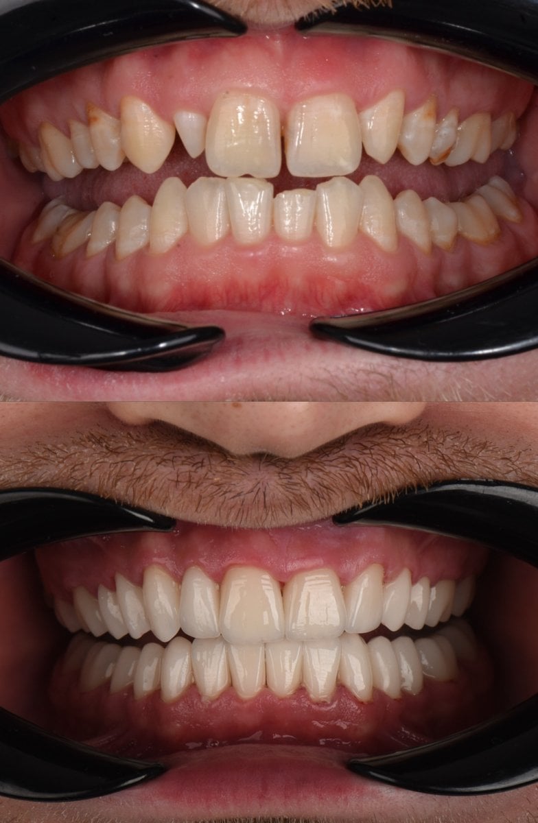 Antes y después de carillas dentales en Astra Dental Clinic – sonrisa natural y renovada