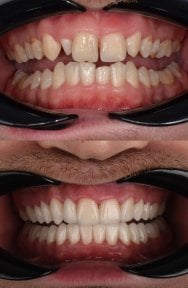 before-after photo installation-of-a-veneer