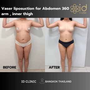 Resultados antes y después de liposucción Vaser 360 abdomen, brazos, muslos en ID Clinic Bangkok