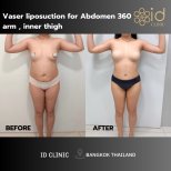 Resultados antes y después de liposucción Vaser 360 abdomen, brazos, muslos en ID Clinic Bangkok