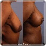 نتائج تصغير الثدي قبل وبعد في NOVİN ARİANA SAĞLIK VE TURİZM LİMİTED ŞİRKETİ