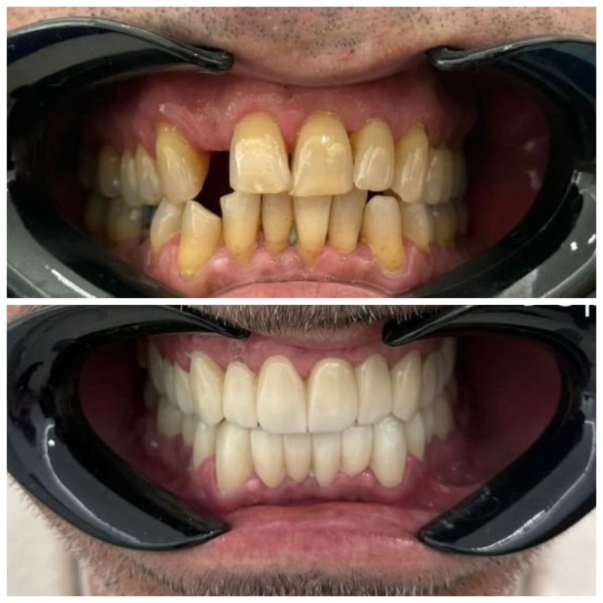 نتائج قبل وبعد تركيب تيجان الزركونيا في Santa Caterina Clinic Dental & Aesthetic Medicine