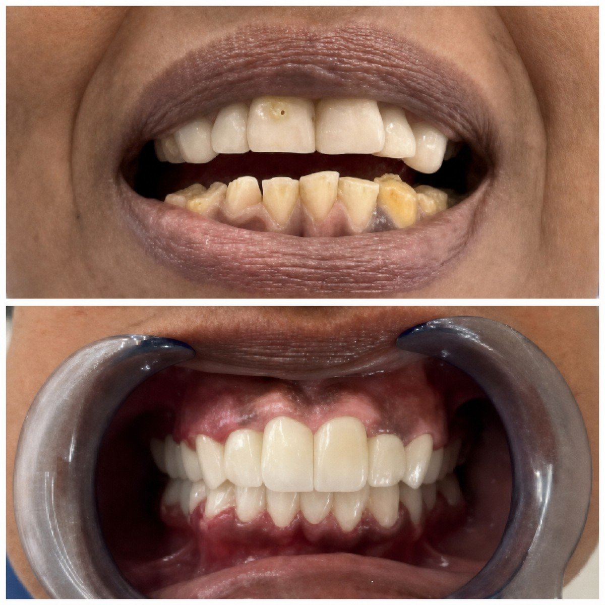 نتائج تركيب تيجان الزركونيا في Santa Caterina Clinic Dental & Aesthetic Medicine قبل وبعد