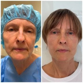 Before and after blepharoplasty results at Radzikowska Plastic Surgery Clinic, eyelid correction