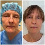 Before and after blepharoplasty results at Radzikowska Plastic Surgery Clinic, eyelid correction