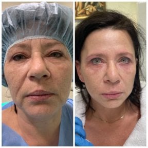 Before and after deep plane facelift results at Radzikowska Plastic Surgery Clinic, facial rejuvenation