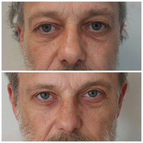 Résultats avant/après blépharoplastie supérieure et inférieure à la clinique Radzikowska